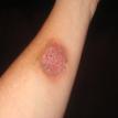 FX fake scab 